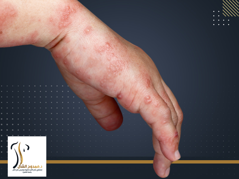 الحزام الناري وعلاجه