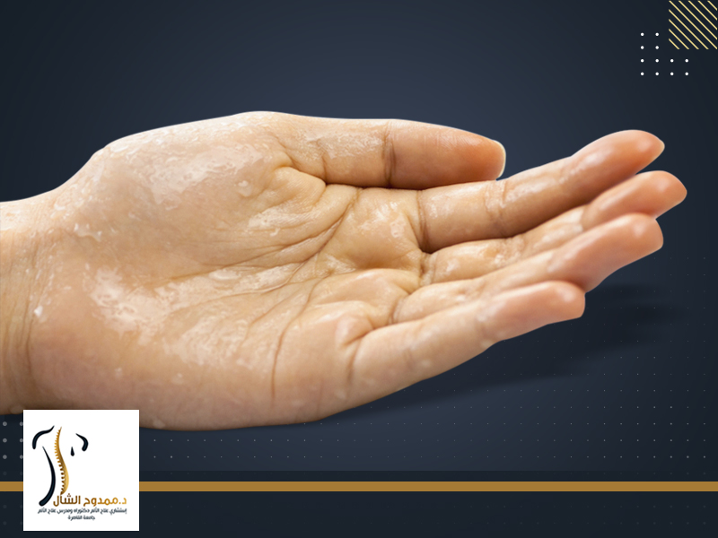 علاج تعرق اليدين