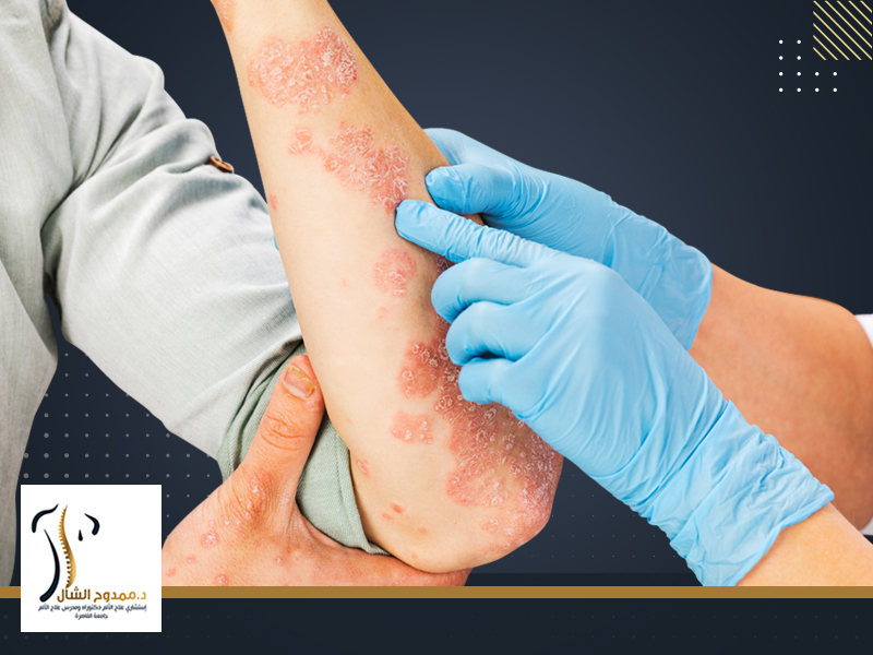 كيف تنتقل عدوى الحزام الناري