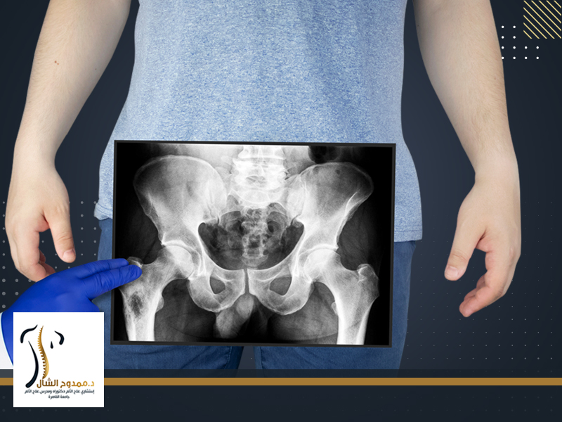 علاج ارتشاح مفصل الحوض والتهابه